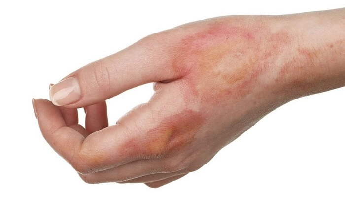 Nằm mơ thấy ai đó làm mình bị bỏng 